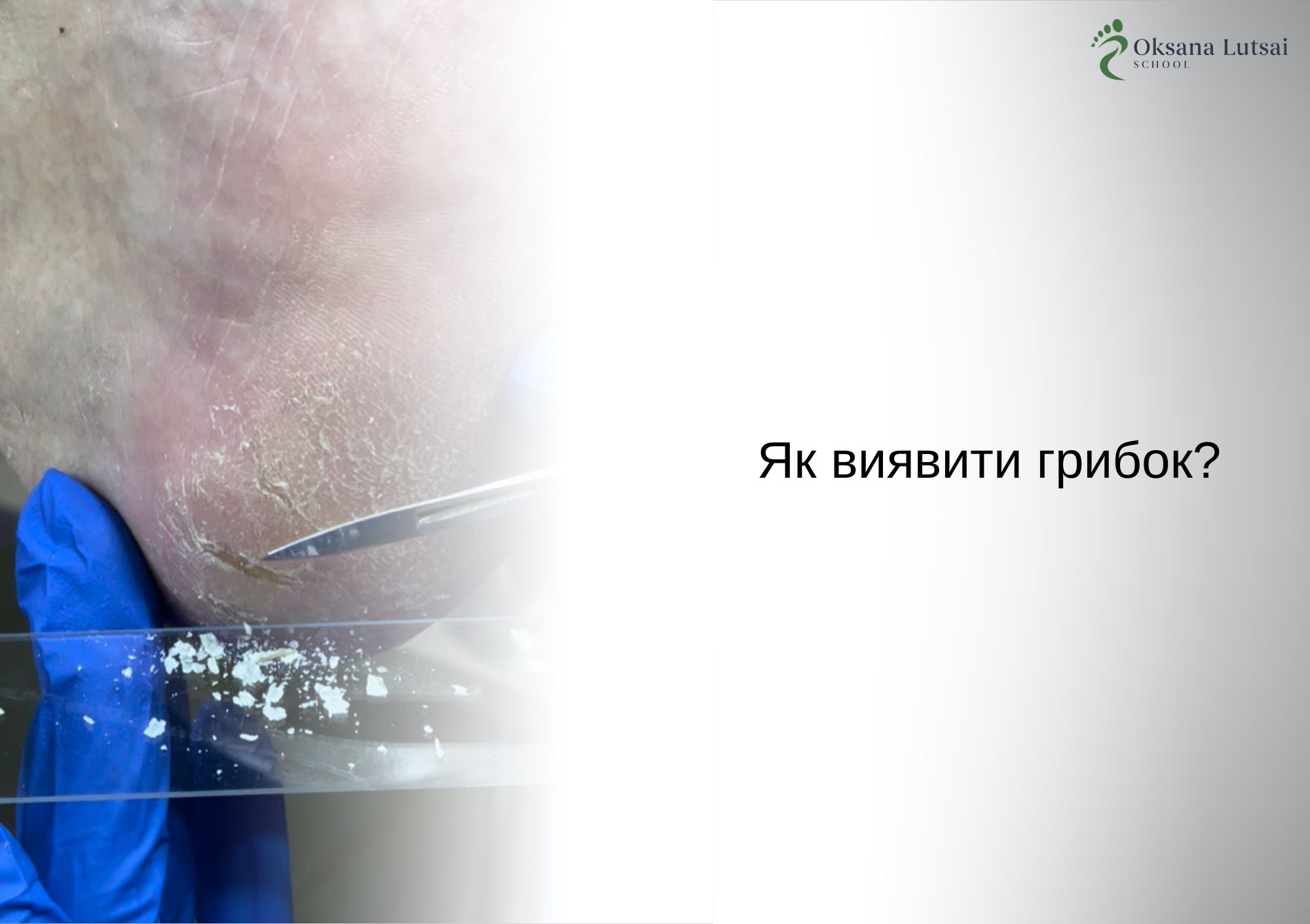Як виявити грибок?