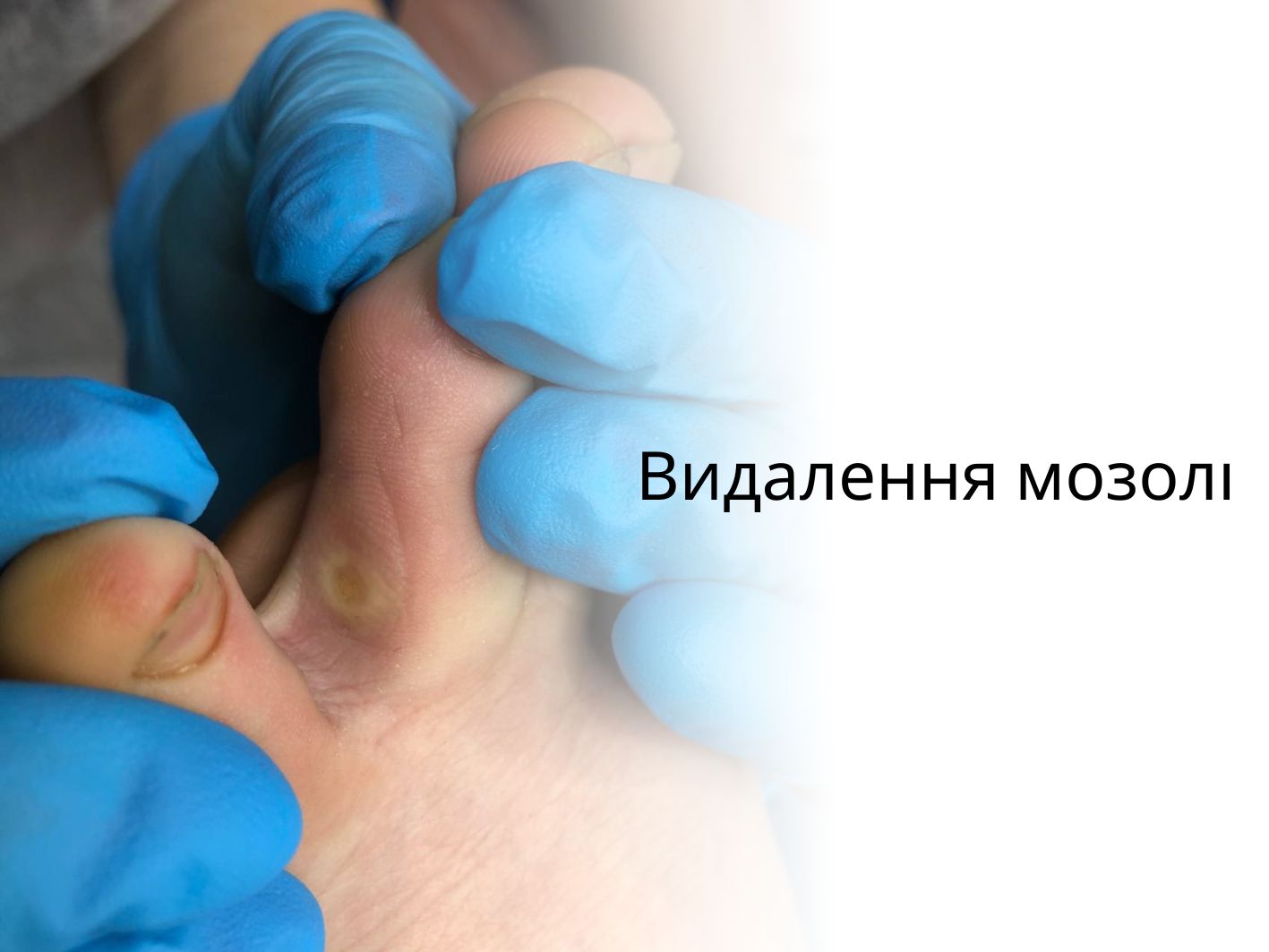 Видалення мозолі