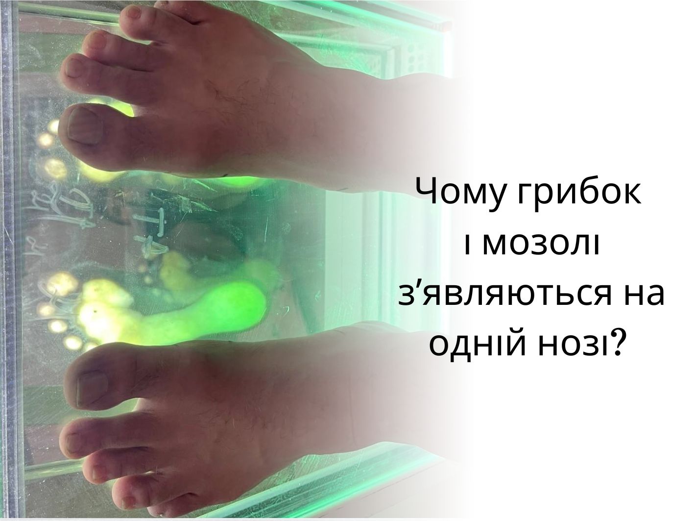 Чому грибок і мозолі зʼявляються на одній нозі?