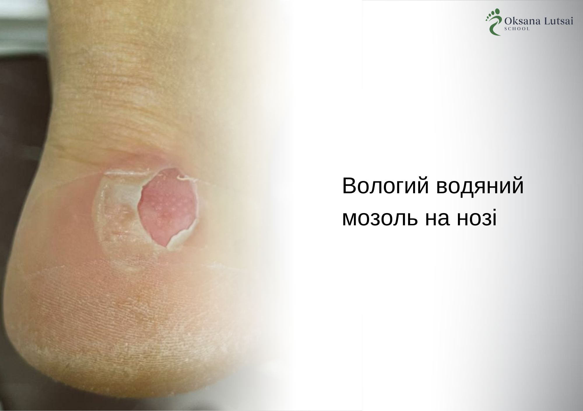 Вологий водяний мозоль на нозі