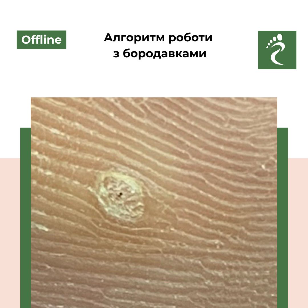 Курс «Алгоритм роботи з бородавками»