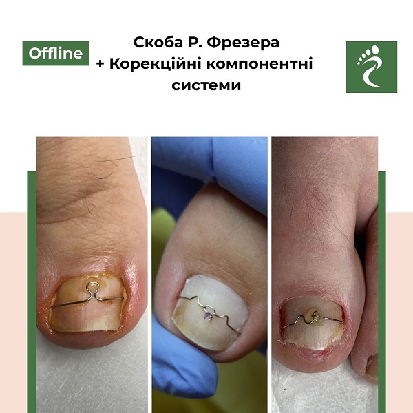 Курс «Скоба Фрезера + Корекційні компонентні системи»