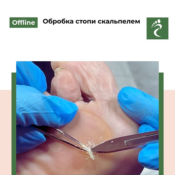 Курс «Обробка стопи скальпелем»