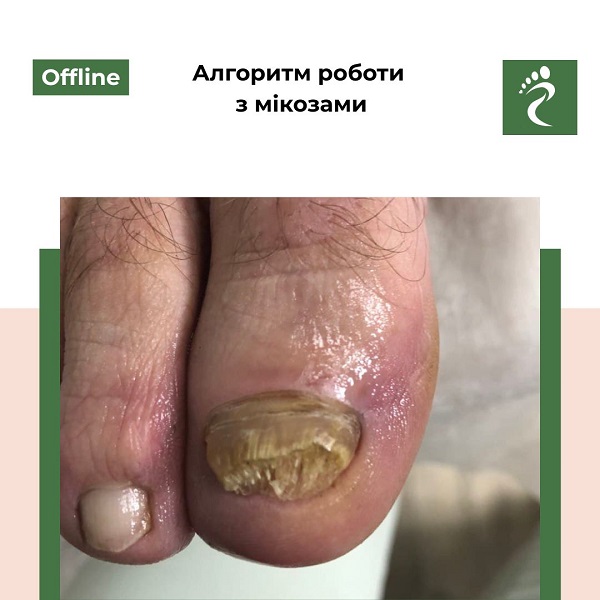 Курс «Алгоритм роботи з мікозами»