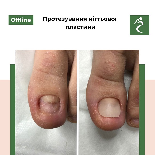 Курс «Протезування нігтьової пластини»
