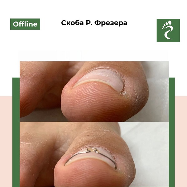 Курс «Скоба Р. Фрезера»