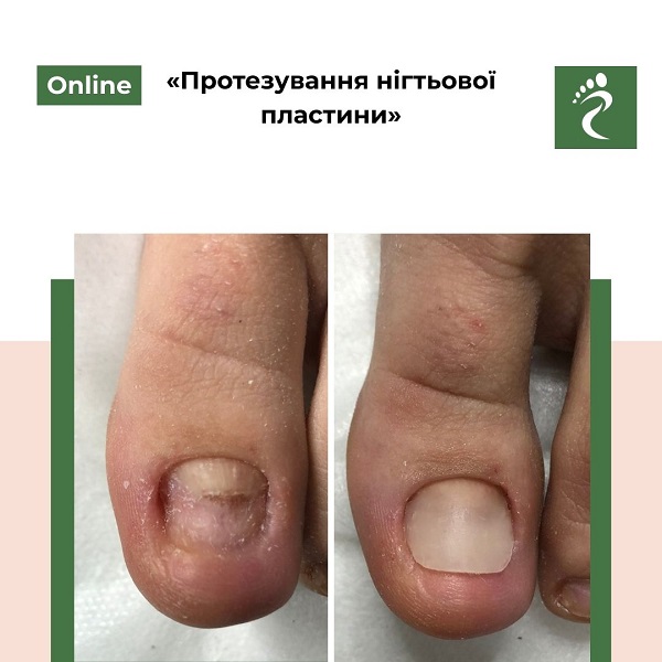 Онлайн курс «Протезування нігтьової пластини»