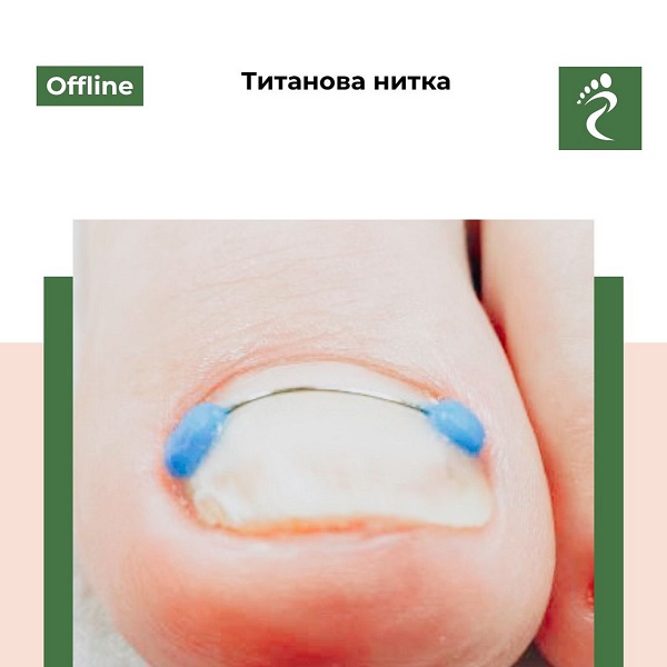 Курс «Титанова нитка»